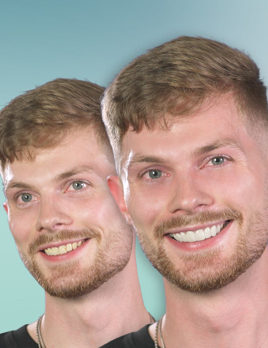 Tand-Veneer 3.0